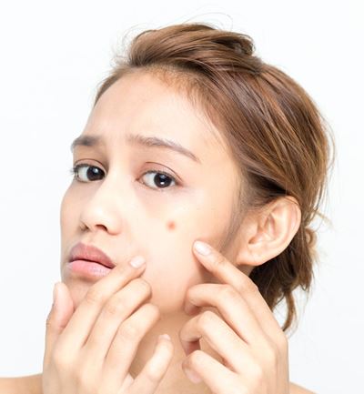 How To Get Rid Of Acne Overnight Safely